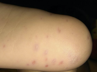 Diagnose The Skin Lesion